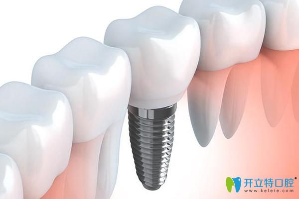 寧波恒美口腔徐路路科普種植牙術(shù)后注意事項(xiàng) 寧波恒美口腔徐路路科普種植牙術(shù)后注意事項(xiàng)