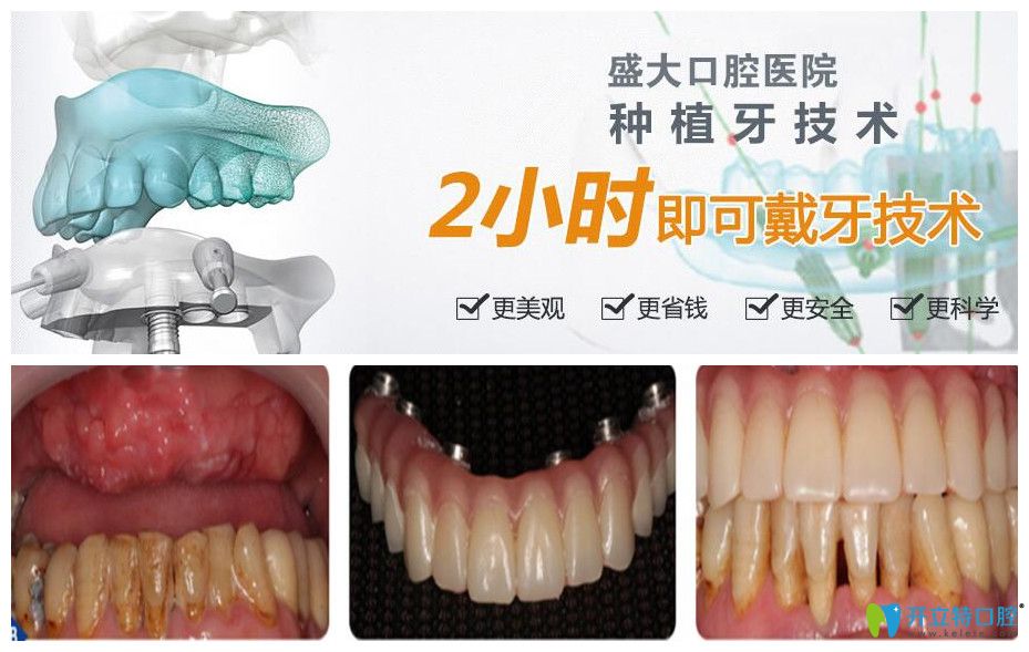 盛大口腔半口牙種植案例