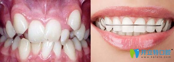牙套保持器是避免牙齒正畸反彈的好幫手