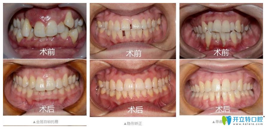 寧波恒美口腔做矯正怎么樣？矯正價格不貴技術(shù)好