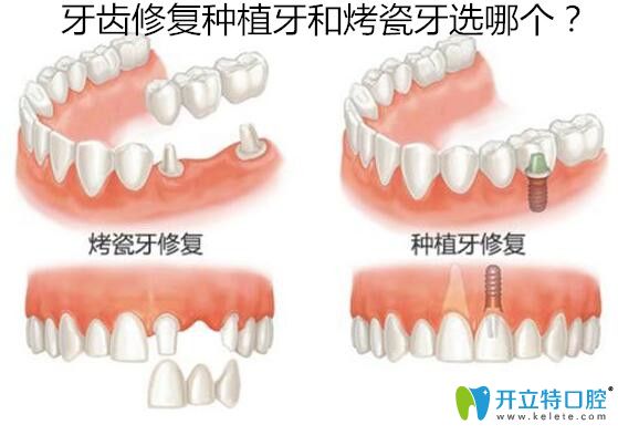 18歲缺失牙齒修復(fù)種植牙和烤瓷牙選哪個？