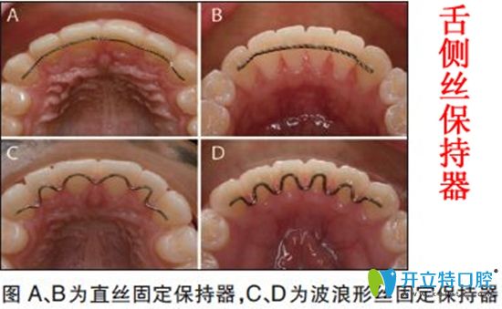 防止牙齒反彈的舌側(cè)絲保持器示意圖