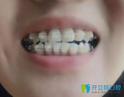 <!--<i data=20240703-sp></i>-->口腔潘少群給我做牙齒矯正第6個(gè)月 <!--<i data=20240703-sp></i>-->口腔潘少群給我做牙齒矯正第6個(gè)月