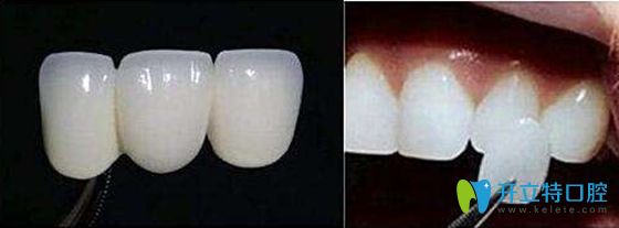 全瓷牙齒貼面展示圖