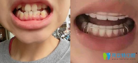 我做牙齒矯正的前后效果對(duì)比圖