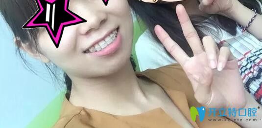 齙牙矯正過程中打骨釘內(nèi)收