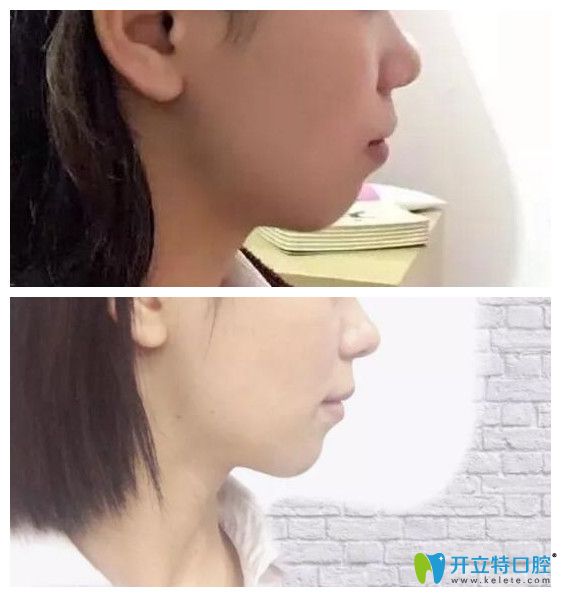 齙牙矯正前后側(cè)臉對比照片