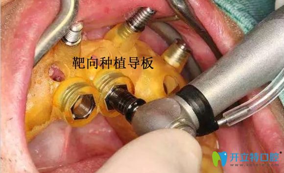 南京博韻口腔種植導(dǎo)板術(shù)中使用圖