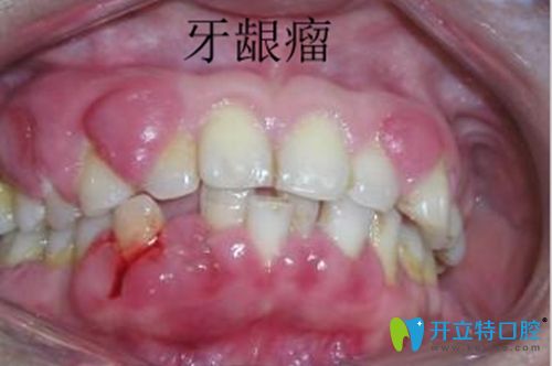 好怕怕!妊娠期牙齦瘤怎么控制?是不是腫瘤？