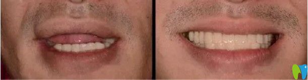 武漢德韓口腔醫(yī)生顧客種植牙前后對比圖