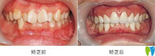 牙齒擁擠不齊在廣大口腔做GA精準矯正效果