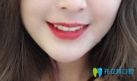 花2萬(wàn)多元在珠海九龍口腔做的隱形矯正效果