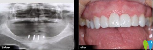 何先生做過種植牙的案列圖