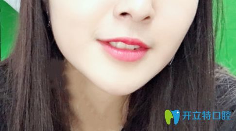 我在珠海九龍口腔做的隱形矯正價(jià)格是2萬(wàn)元起