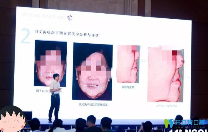 北京維樂口腔時紹忠美學修復(fù)講解圖