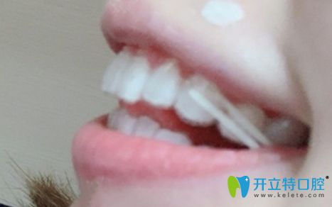 戴隱形牙套矯正一年的效果圖 戴隱形牙套矯正一年的效果圖
