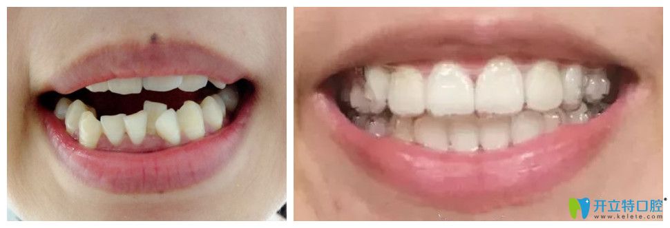 通過真人案例效果來判斷適美樂隱形正畸怎么樣