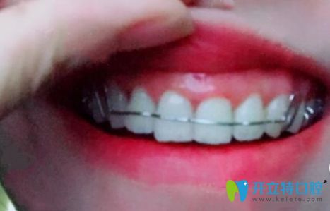 從隱形牙套轉(zhuǎn)入保持器階段 從隱形牙套轉(zhuǎn)入保持器階段