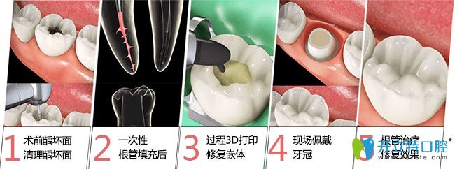 南京博韻口腔魏厚星醫(yī)生介紹根管治療注意事項(xiàng)