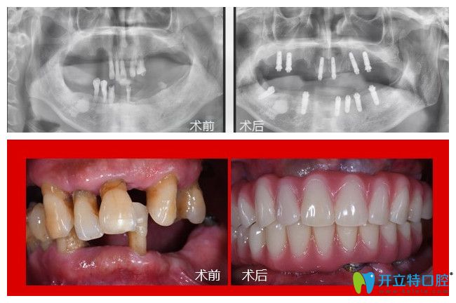 75歲郭老在廣州廣大口腔做了全口種植牙1年多后來(lái)反饋感受