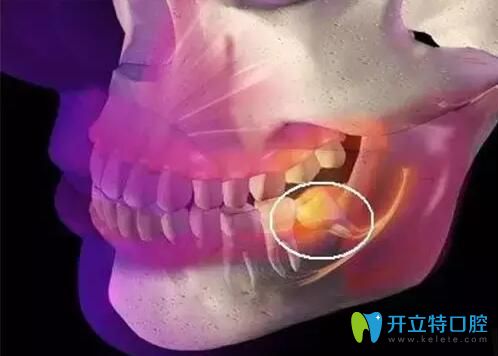 智齒冠周炎膿腫圖片