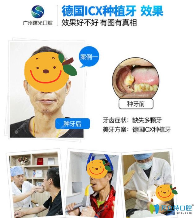 曙光口腔德國(guó)ICX種植牙效果展示