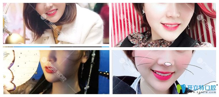 齙牙妹在曙光口腔矯正牙齒效果圖