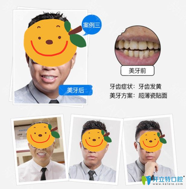 廣州瓷貼面哪家做的好？在曙光口腔做了牙貼面顧客用效果來說話