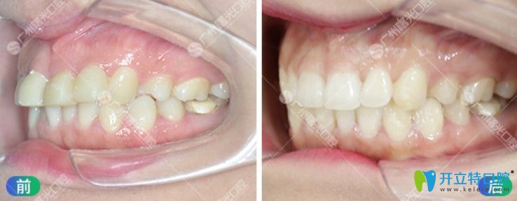 曙光口腔齙牙矯正前后對比照片