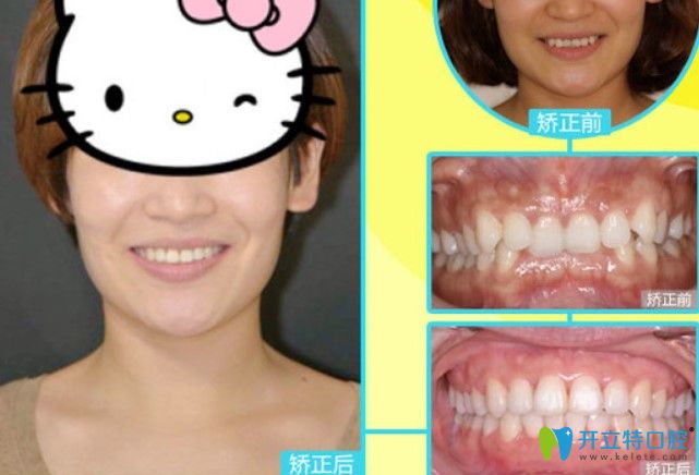 長(zhǎng)沙中諾口腔深覆合+牙齒擁擠矯正案例