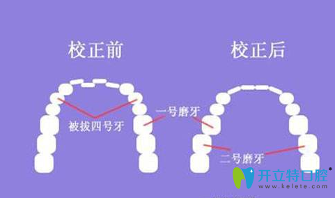 牙齒矯正的前后效果圖 牙齒矯正的前后效果圖