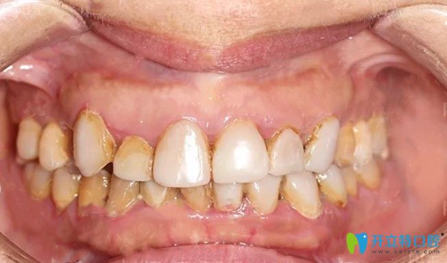 做完樹(shù)脂貼面3年后的牙齒情況 做完樹(shù)脂貼面3年后的牙齒情況