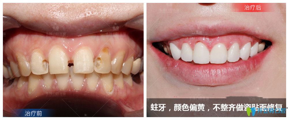 ↓蛀牙、顏色偏黃，不整齊做了瓷貼面修復(fù)后牙齒大變樣