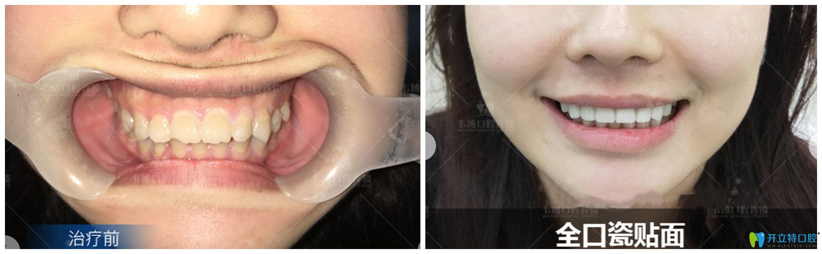 牙齒發(fā)黃，還缺損的小姐姐用瓷貼面來“武裝”牙齒