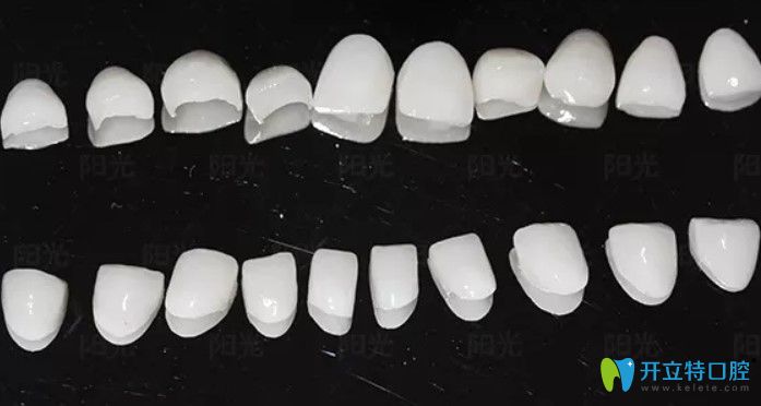 牙齒修復(fù)瓷貼面圖示 牙齒修復(fù)瓷貼面圖示