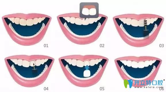 備受追捧的牙齒貼面材料選全瓷、硬質(zhì)和樹(shù)脂貼面哪個(gè)好