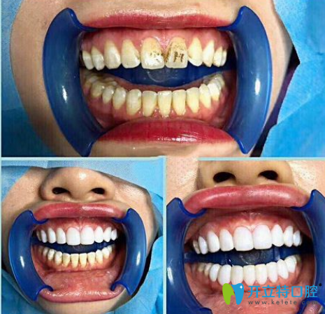 牙齒貼片前后對(duì)比