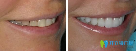 德國義獲嘉瓷貼面修復(fù)效果圖