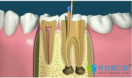 徐濤醫(yī)生科普根管治療的相關(guān)知識(shí)