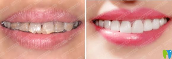 美加超薄瓷貼面修復(fù)效果圖