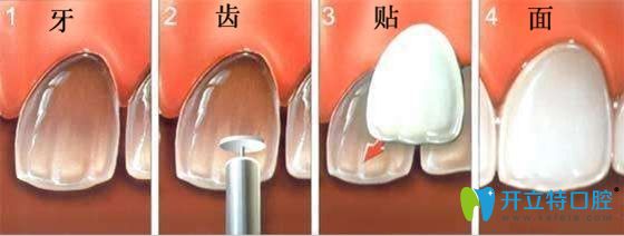 牙齒貼面效果圖展示