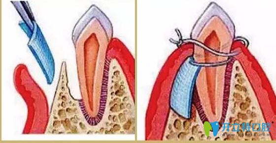 人工骨粉在臨床較為常用