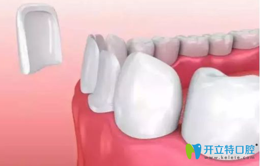 牙齒貼面有后遺癥？千萬(wàn)別做樹(shù)脂牙齒貼面的真相