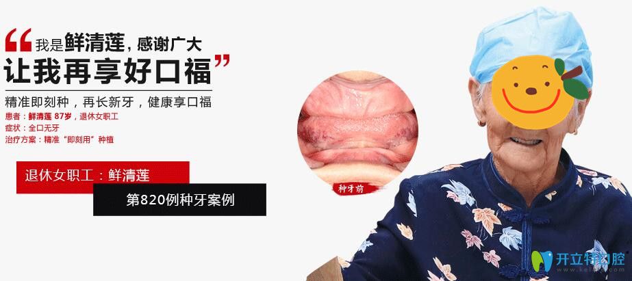 廣大口腔為87歲拉破人做精準即可種植牙案例效果圖