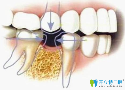 拔除牙根不及時(shí)補(bǔ)牙的危害
