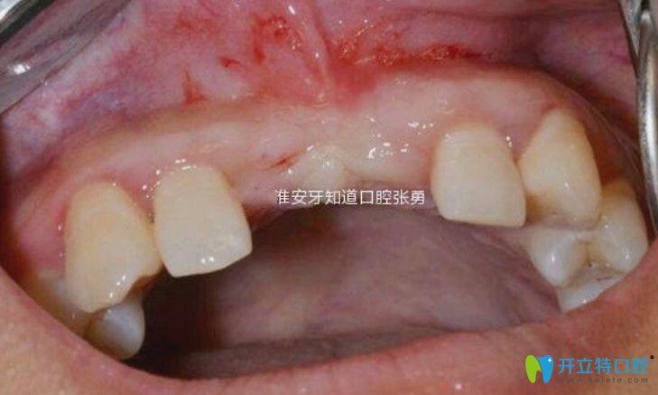 淮安哪里做種植牙好？顧客反饋淮安牙知道張勇種牙水平高