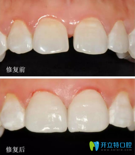 牙齒超薄貼面怎么樣？多少錢一顆？也許這個(gè)是你更關(guān)心的