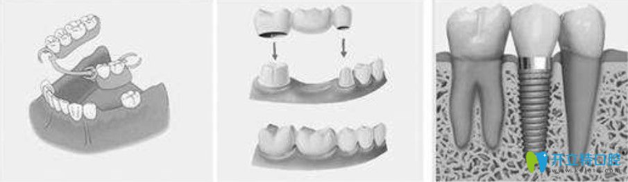 孔紅梅醫(yī)生告訴你種植牙、固定假牙和活動義齒相比有什么區(qū)別