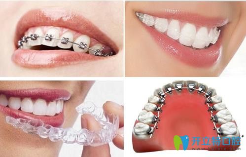 牙齒矯正的幾種方法圖