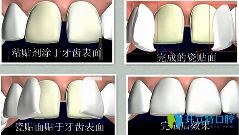 牙齒貼面的過程